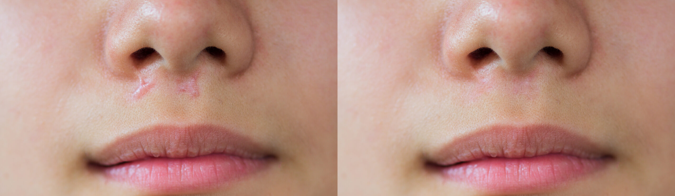 Narbenlaser Lipo Vital