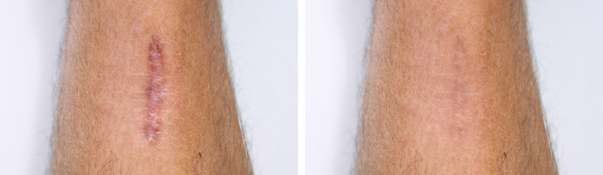 Narbenbehandlung bei Lipo Vital
